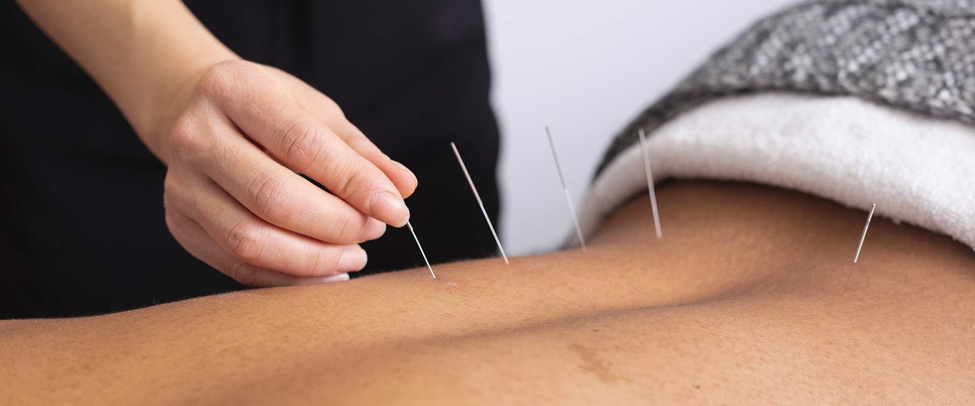 Acupuncture Therapy