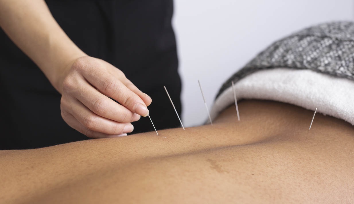 Acupuncture Needles